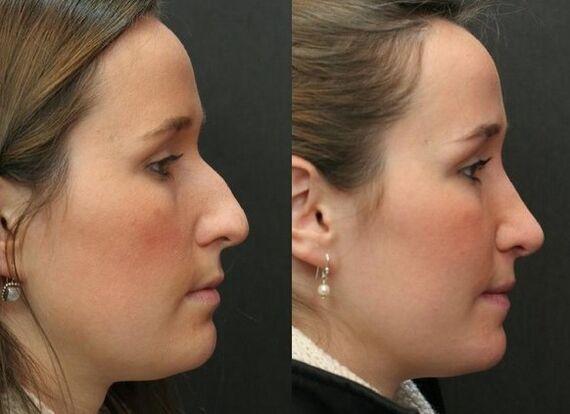Before and after non -surgical rhinoplasty