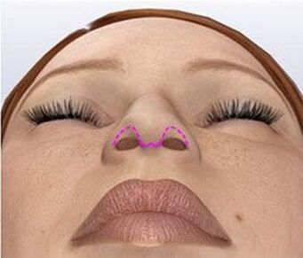 Nasal correction