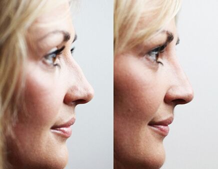 Before and after rhinoplasty with fillers