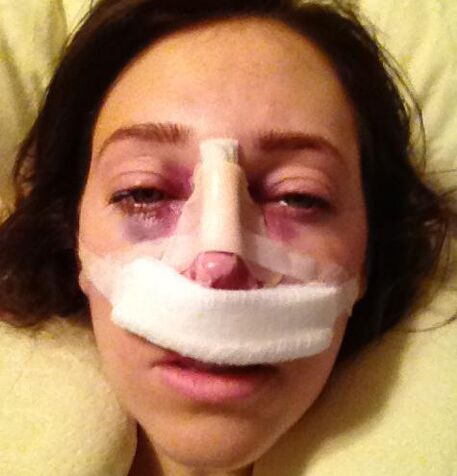 After surgery, a plaster bandage is applied to the nose