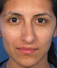Irregular nose shape is a reason for plastic surgery