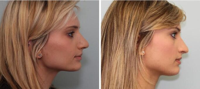 Rhinoplasty results before and after