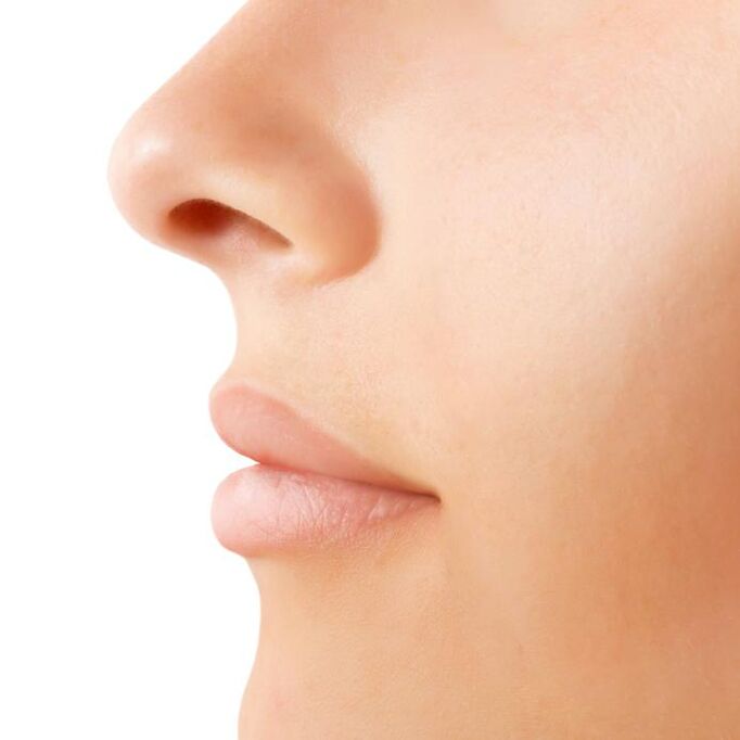 open rhinoplasty result