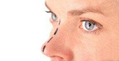 Marking on the nose for insertion of cosmetic threads