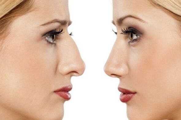 rhinoplasty of the nose to eliminate hump