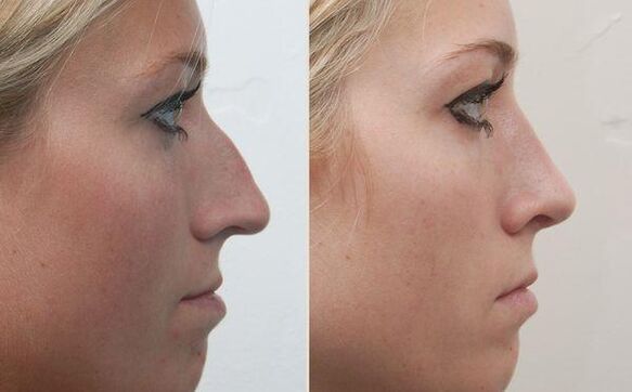 the result of rhinoplasty of the nose