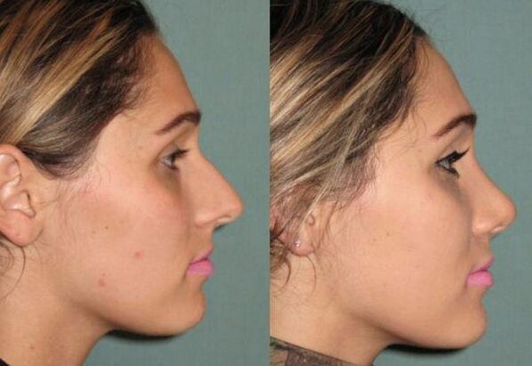 the result of rhinoplasty without injection