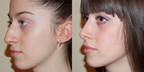 photos before and after nasal rhinoplasty