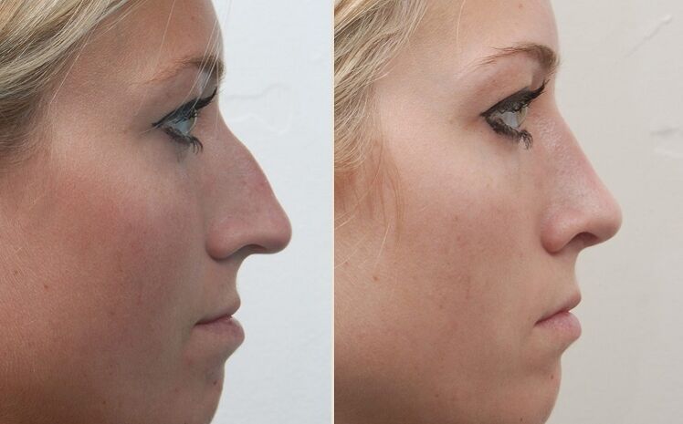 before and after rhinoplasty