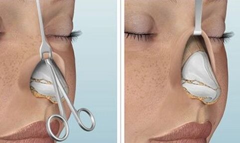 open nose rhinoplasty
