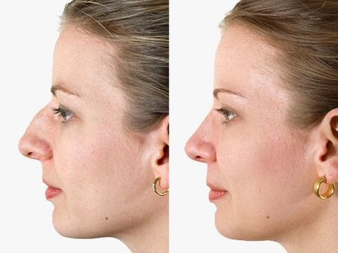 photos before and after rhinoplasty