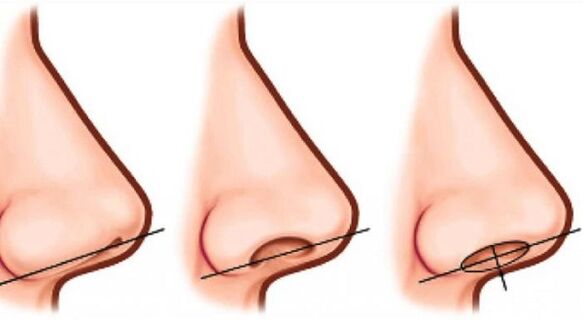 nose tip correction
