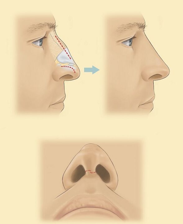 scheme for nose rhinoplasty