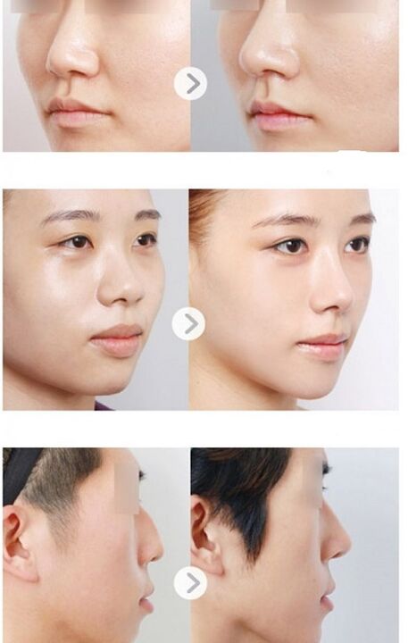 before and after non-surgical rhinoplasty