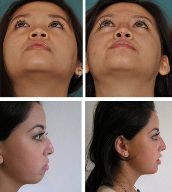 photos before and after rhinoplasty without surgery
