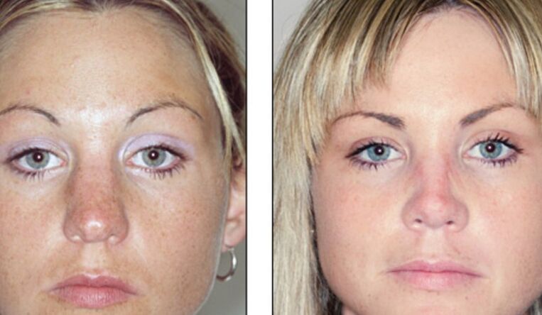 Before and after failed nasal rhinoplasty
