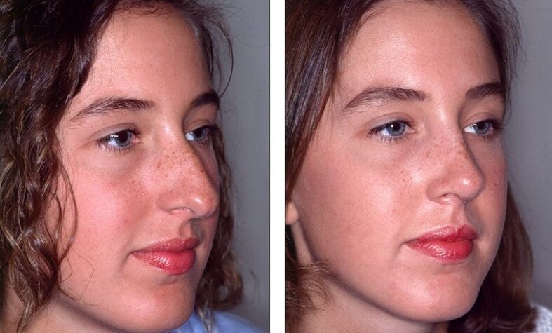 Nose before and after failed rhinoplasty