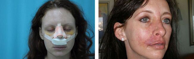 complications after rhinoplasty