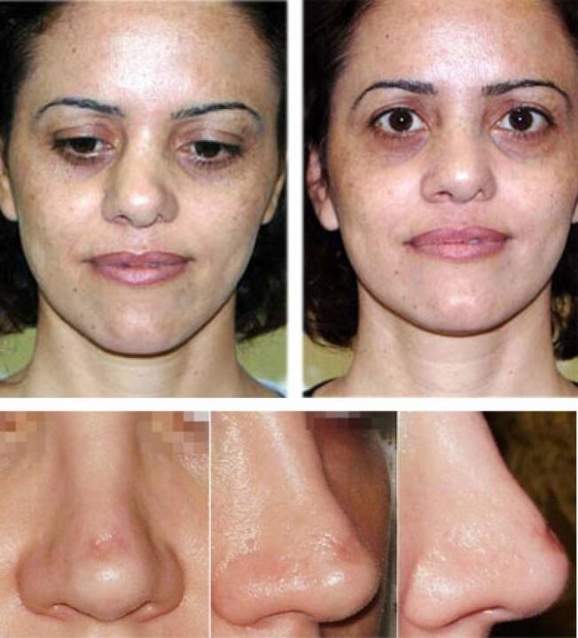 photos before and after rhinoplasty