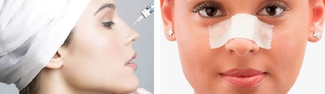 rhinoplasty injection