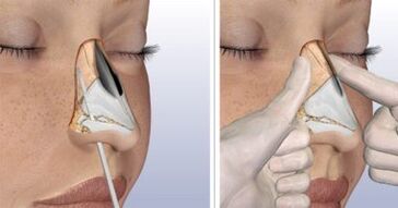 Nose removal in Israel