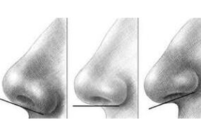 Nose tip correction in Israel
