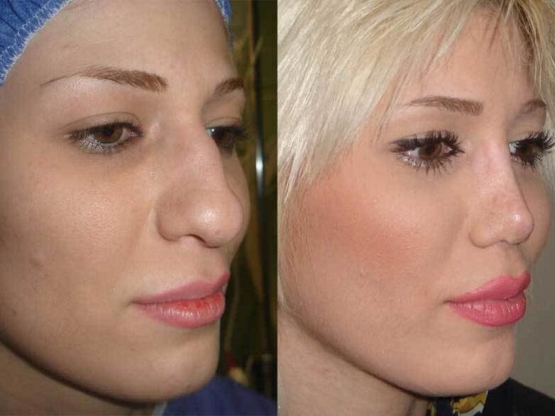 before and after rhinoplasty