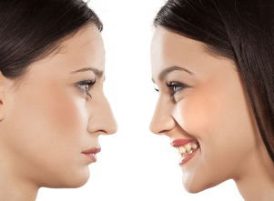 Rhinoplasty nose before and after