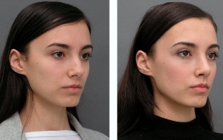 Girl before and after rhinoplasty nose