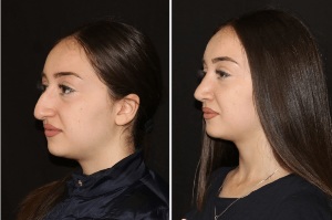 The result of the straightening of the nose after rhinoplasty