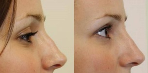 the tip of the nose before and after