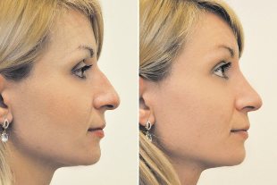 Non-surgical rhinoplasty before and after photos